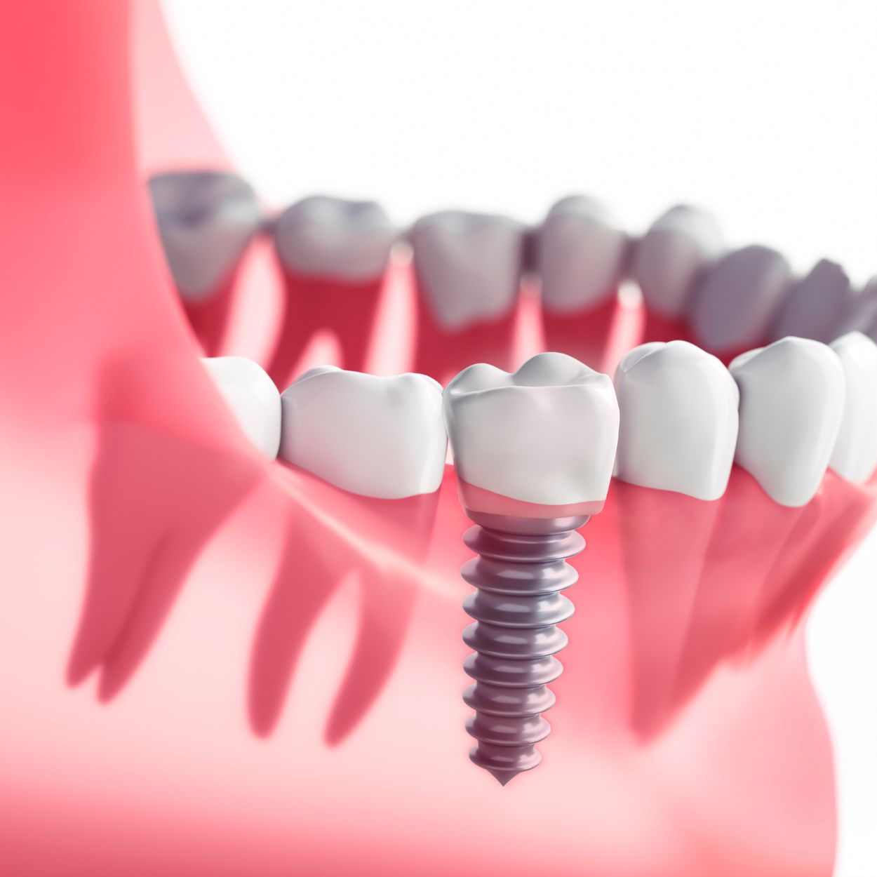 Dental impant